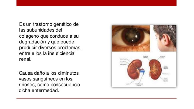sindrome de alport